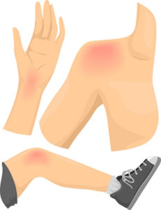 Knee, Shoulder, and Wrist Injuries Attorney in San Jose, CA